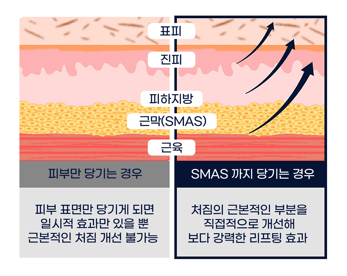 SMAS층 SMAS층 개선